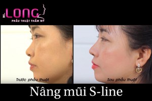 nang-mui-sline-co-chinh-hinh-vach-ngan-co-duoc-khong-1