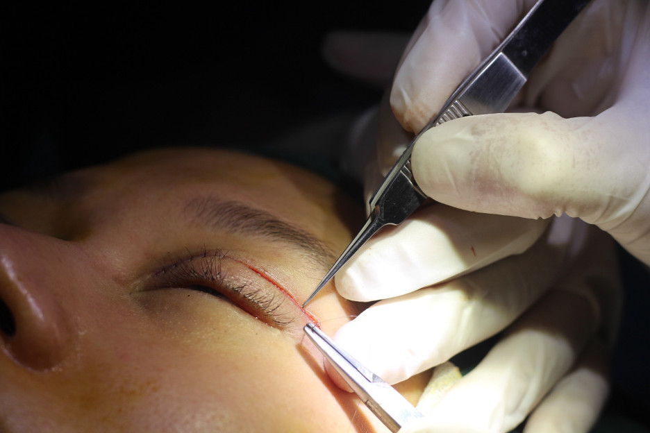 Quá trình phẫu thuật nâng mí mắt không đau chỉ diễn ra trong khoảng 1 tiếng