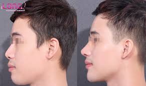 độn cằm nam giới