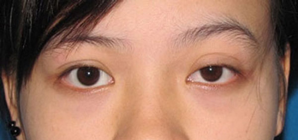mắt bị yếu cơ nâng mi