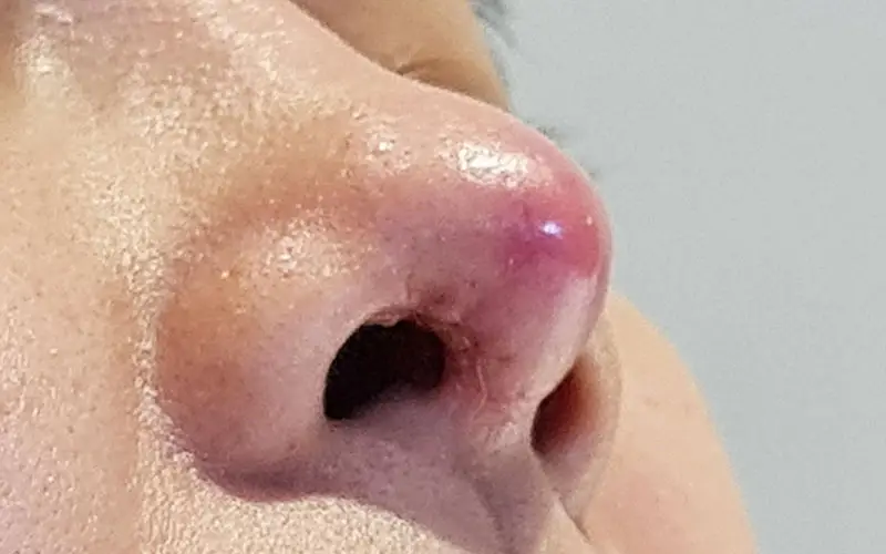 nâng mũi bị viêm