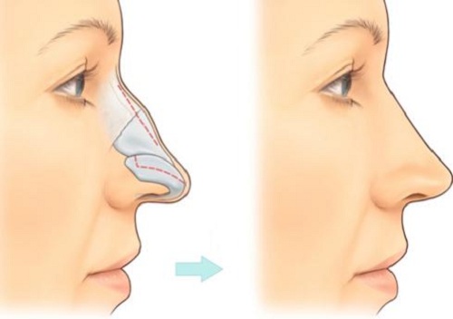 mũi gồ có sửa thẳng được không