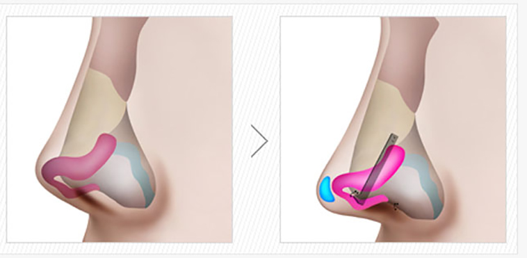 nâng mũi dựng trụ vách ngăn