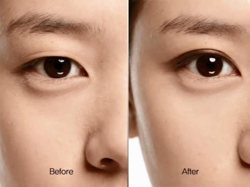 bấm mí mắt giữ được bao lâu
